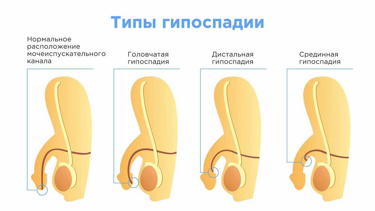 Урология » Выбор метода уретропластики у больных дистальной и среднестволовой гипоспадией